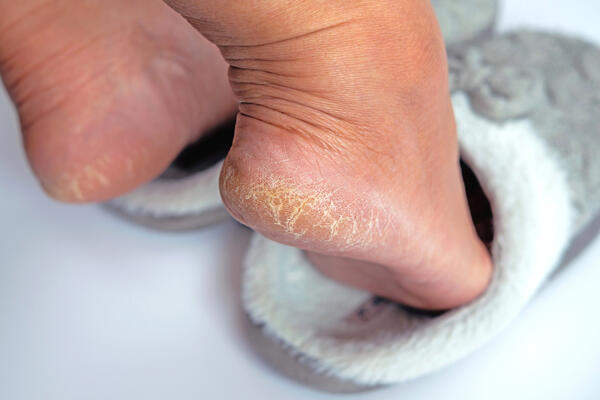 Kako vratiti mekoću isušenim i ispucalim petama? 4 Jeftina trika koje pedikir majstori kriju kako bi imali posla