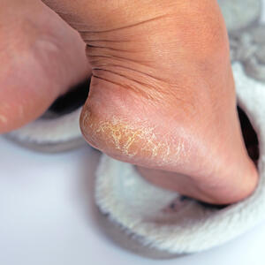 Kako vratiti mekoću isušenim i ispucalim petama? 4 Jeftina trika koje pedikir majstori kriju kako bi imali posla