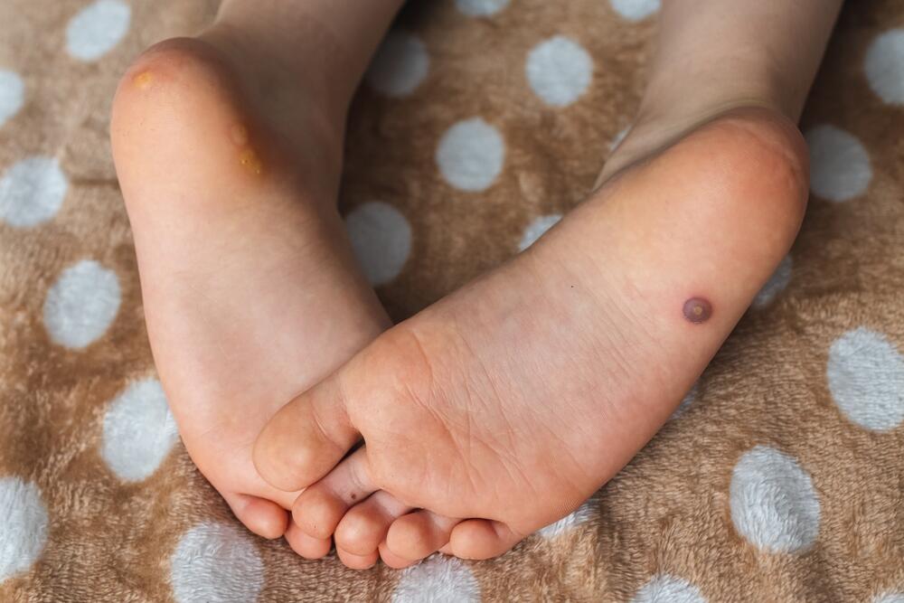 Virusne bradavice koje nastaju na stopalima se nazivaju plantarnim bradavicama