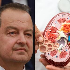 Ivica Dačić ne boluje samo od upale pluća, ovu bolest je ignorisao godinama, a tiho razara sve organe: Srbi je zanemaruju dok stanje ne postane opasno